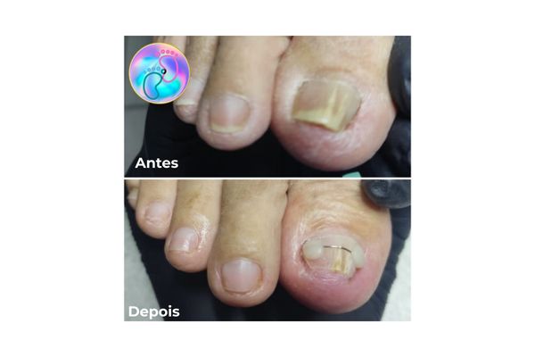 antes e depopis 1